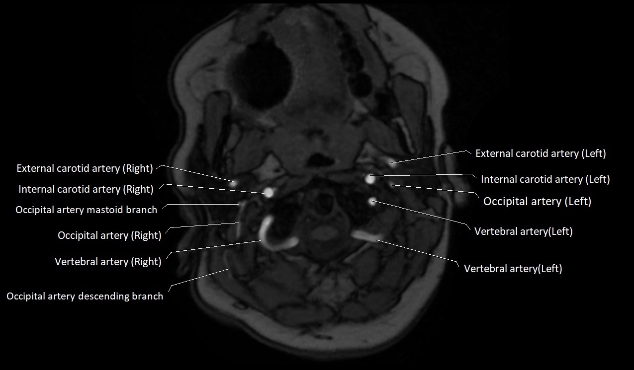 Carotid artery anatomy axial 3T image 12.jpg